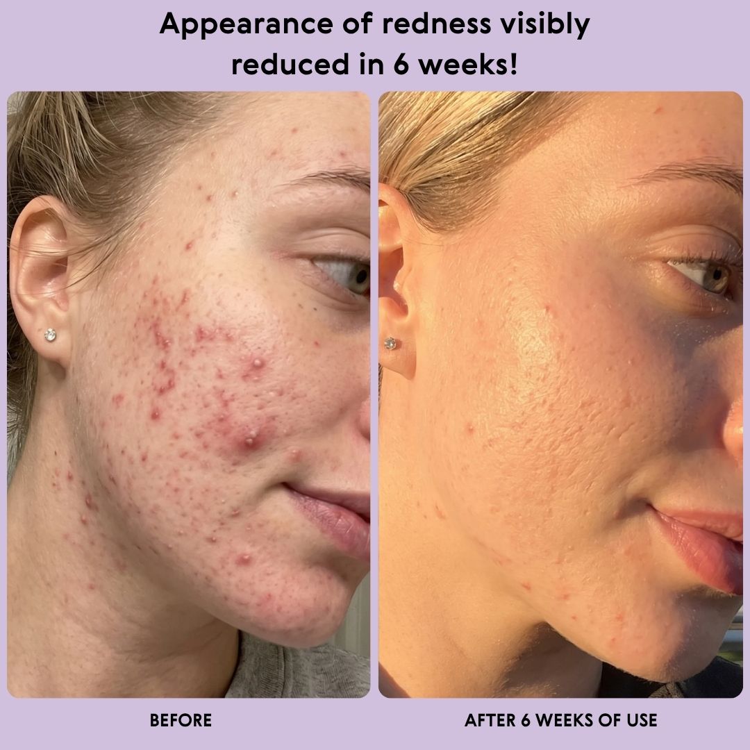 Before and after comparison showing visibly reduced redness after 6 weeks of using Bambuyu face towels